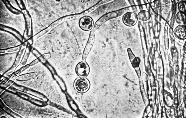  82.  Candida albicans , 9-12  ,     .     .    .    . X 1000. 